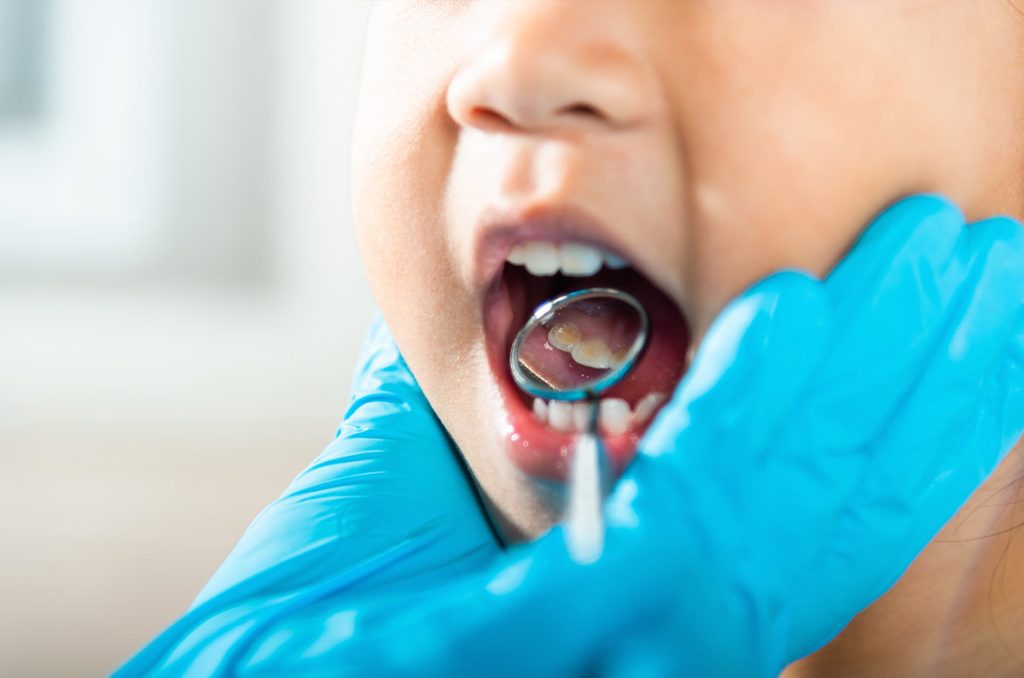 Caries en las muelas de leche