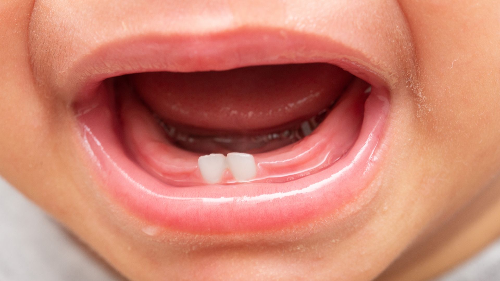 boca de un bebe con dos dientes de leche erupcionando